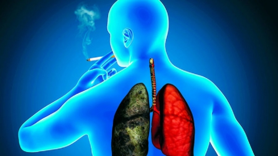El de pulmón es el cáncer que más mata en el mundo