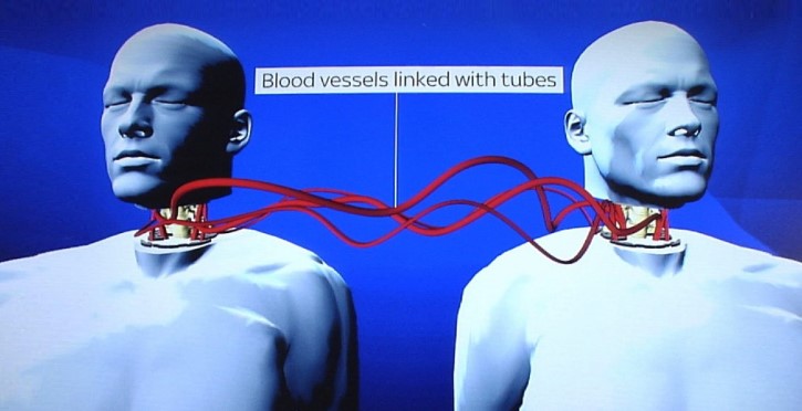 Trasplante de Cabeza y Robot Médico serán realidad en 2018