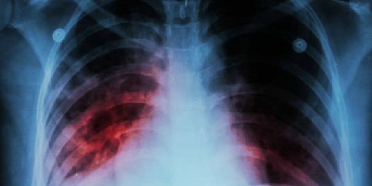 La tasa de casos de tuberculosis ha aumentado a nivel país