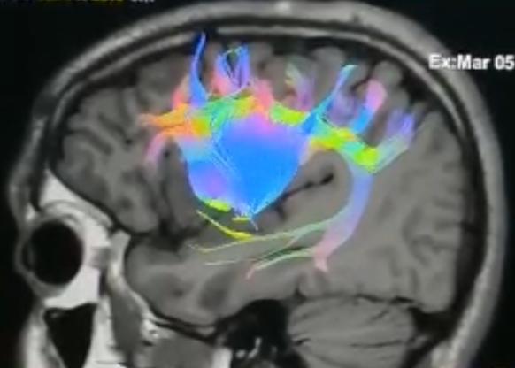 Logran con éxito la primera neurocirugía de un tumor cerebral